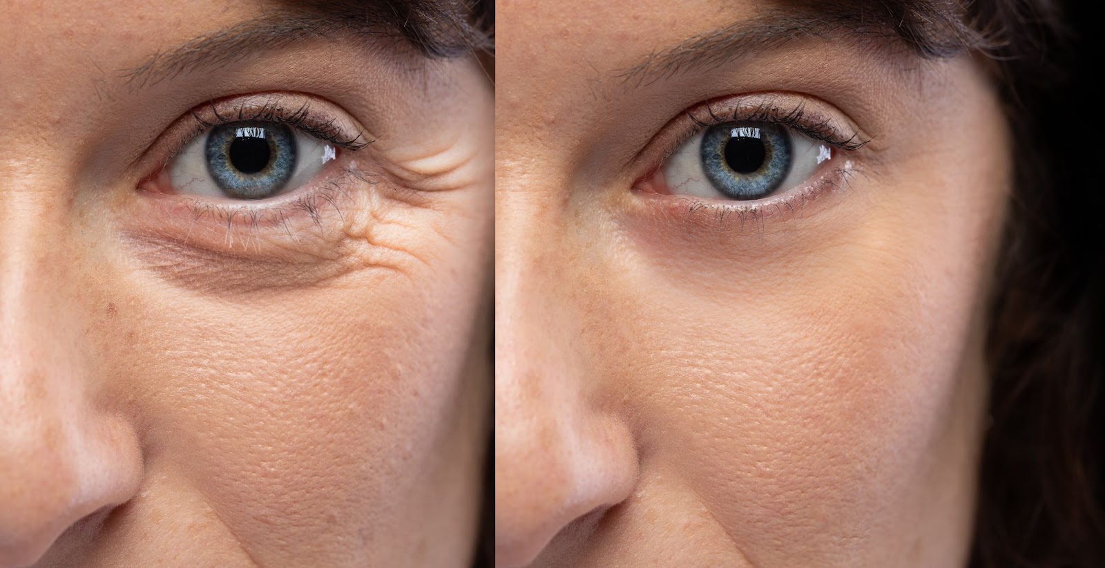 How Long Does Botox Last What You Need To Know