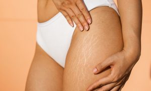 Read more about the article Solved! – Why Are My Stretch Marks Itchy?