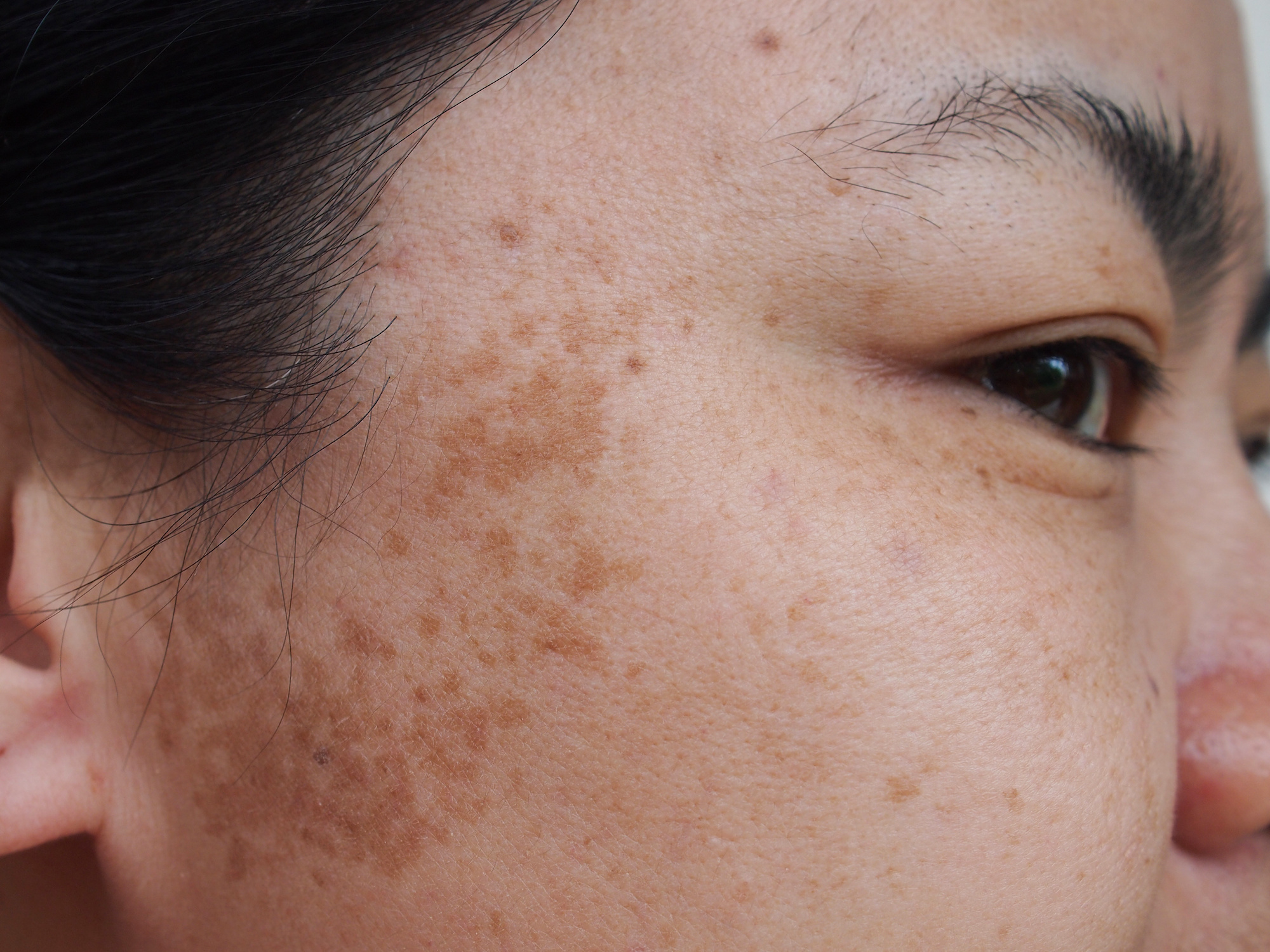Read more about the article Removing Skin Pigmentation – Tips & Advice