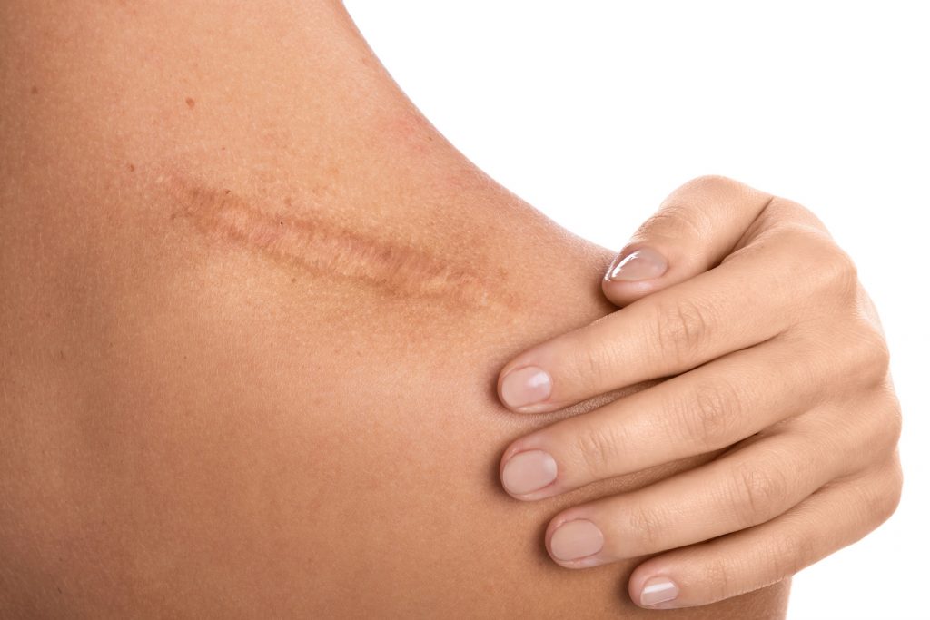 what is scar revision surgery