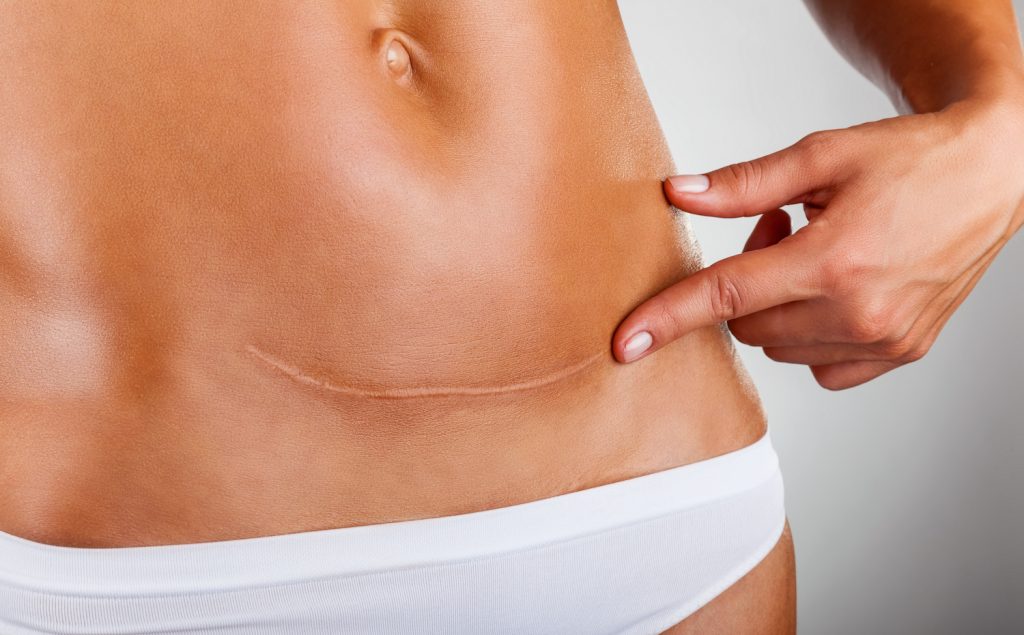 what is scar revision surgery