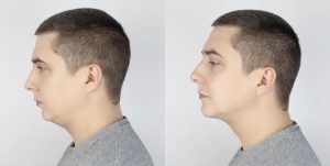 Read more about the article How to Get Rid of Double Chin: A Comprehensive Guide for Men