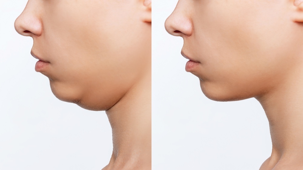 Double Chin Removal Sydney