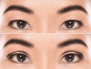 Read more about the article Eyelid Surgery Recovery: 9 Ways to Bounce Back Faster