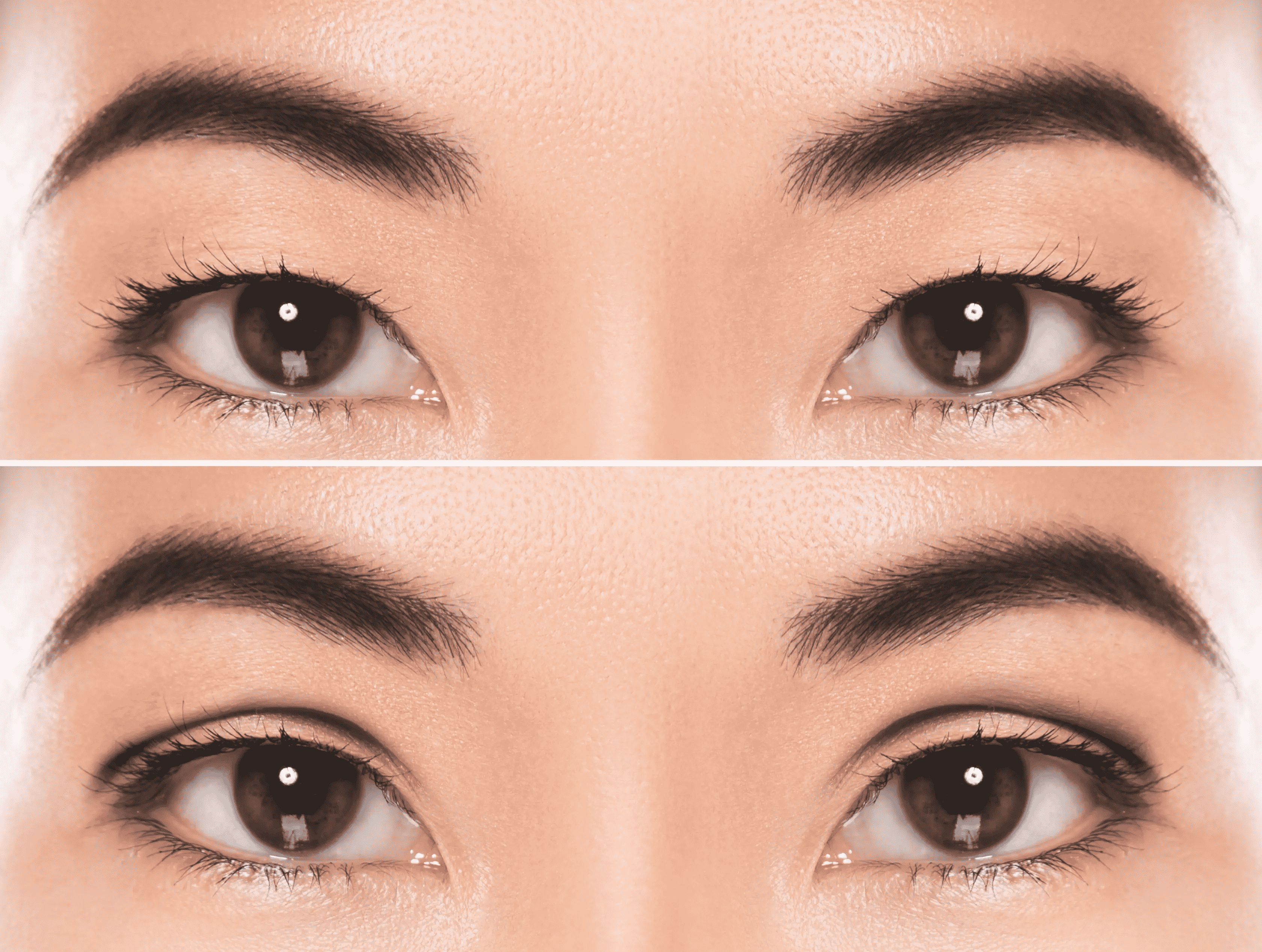 Read more about the article Eyelid Surgery Recovery: 9 Ways to Bounce Back Faster