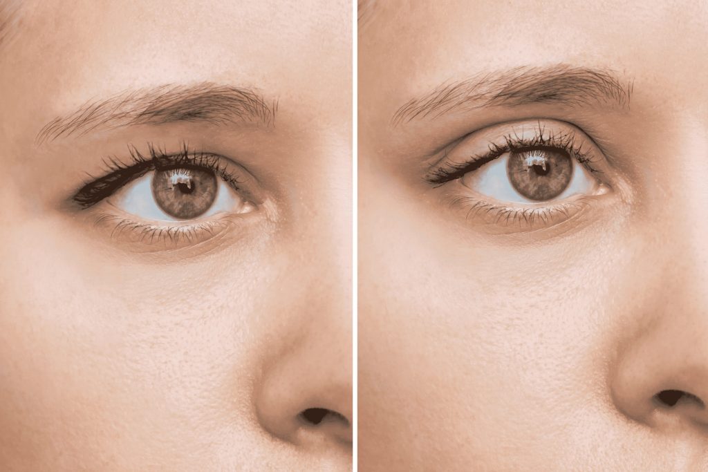 Eyelid Surgery Recovery