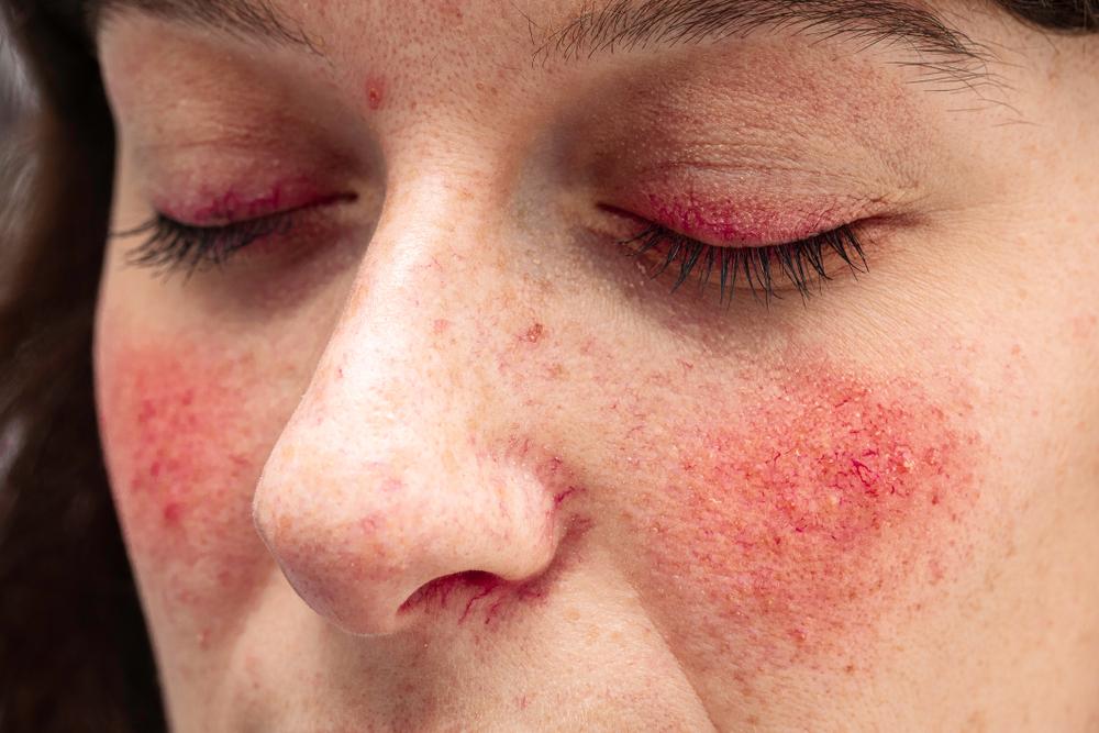 Close-up of a woman with facial redness and skin irritation.