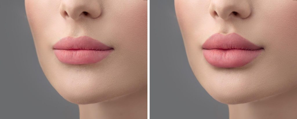 Lip fillers: before and after 